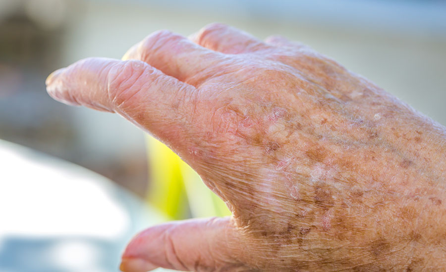 An elderly hand with liver spots
