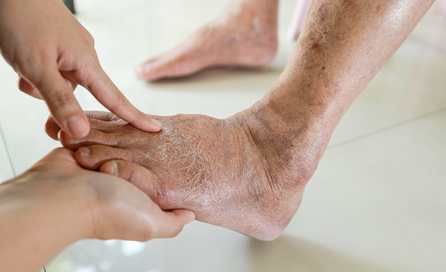 An elderly patient's dry foot