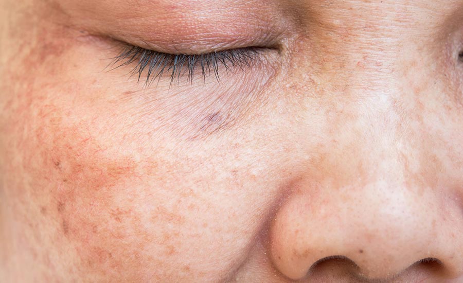 A senior's face with liver spots