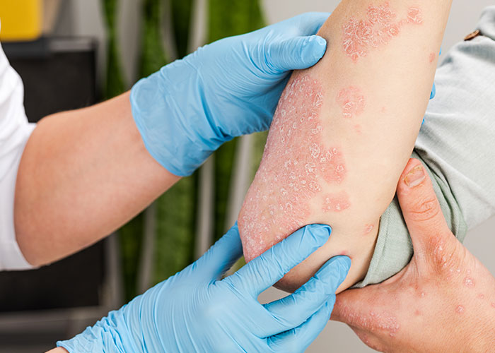 Managing Psoriasis Flare-Ups: Tips for Seniors